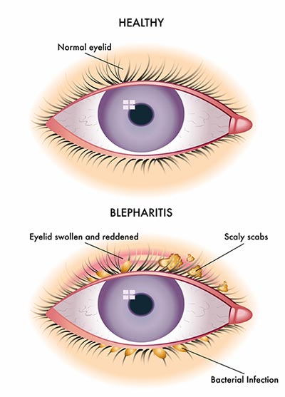Cleaning Your Eyelids to Treat Dry Eyes