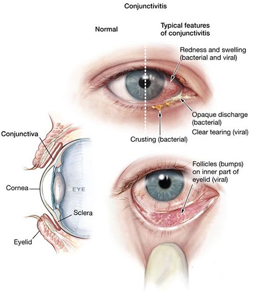 Conjunctivitis Pink Eye Treatment NYC 