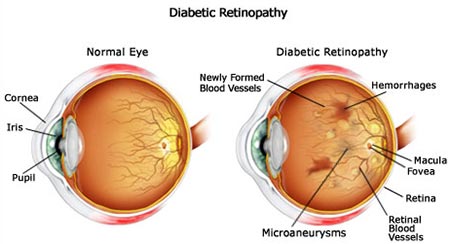 Diabetic neuropathy in the eyes