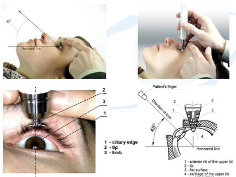 Tonometry, Eye Pressure Test · NYC Eye Doctor · Ophthalmologist in NYC