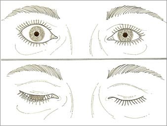 eyelid retraction