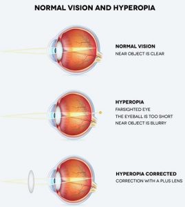 Lazy Eye (Amblyopia) Treatment · Eye Specialist · NYC Ophthalmologist