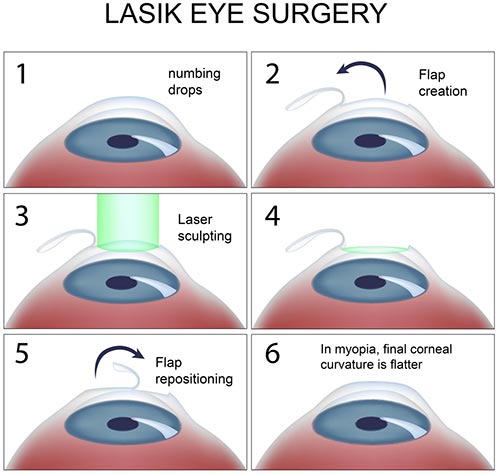 LASIK Eye Surgery · Top Eye Specialist 