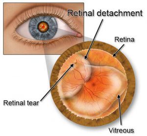 retina detachment surgery