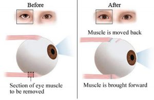 Strabismus (Cross Eyed) Treatment · Best Optometrist, Ophthalmologist ...