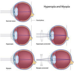 Refractive Error Treatment · Top Rated Eye Doctor · NYC Ophthalmologist